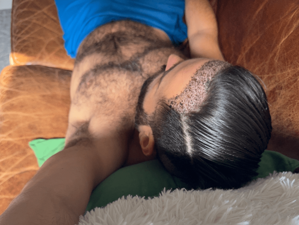 LGBTQ+ Welcoming Hair Transplant in Istanbul